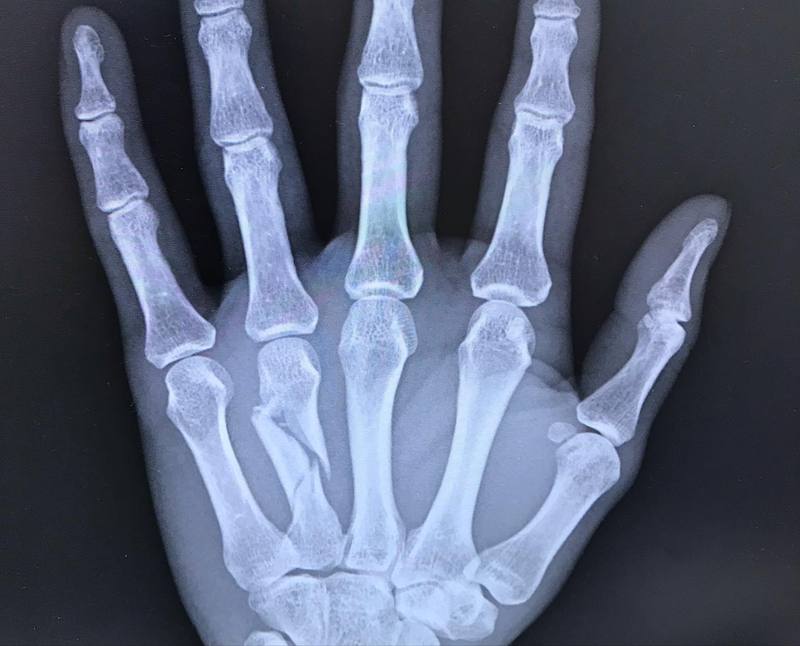認定ハンド 両手 右手骨折2本有り 認定ハンド 両手 右手骨折2本有り